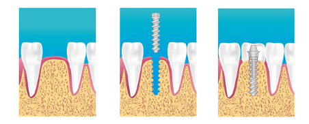 Implants dentaires Angouleme
